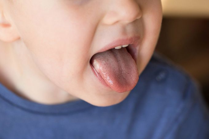 Як лікувати стоматит у дітей?